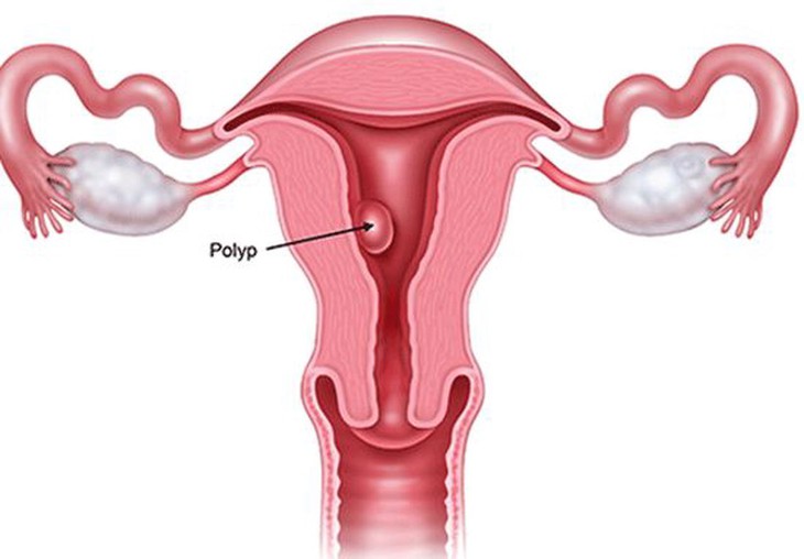 Polyp buồng tử cung gây ảnh hưởng khả năng sinh sản thế nào?- Ảnh 1. Polyp buồng tử cung gây ảnh hưởng khả năng sinh sản thế nào?- Ảnh 1.