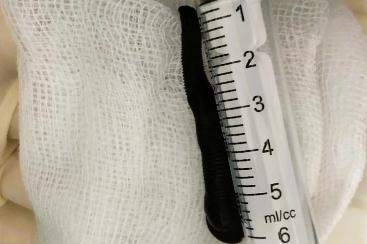 Con đỉa 6 cm bò trong khí quản người đàn ông, nghi ngờ do uống nước suối- Ảnh 2.