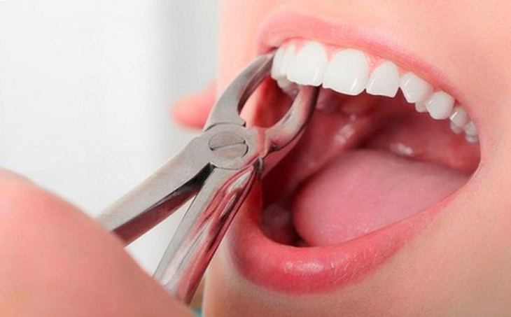 Những nhận định sai lầm khi nhổ răng- Ảnh 1. Những nhận định sai lầm khi nhổ răng- Ảnh 1.