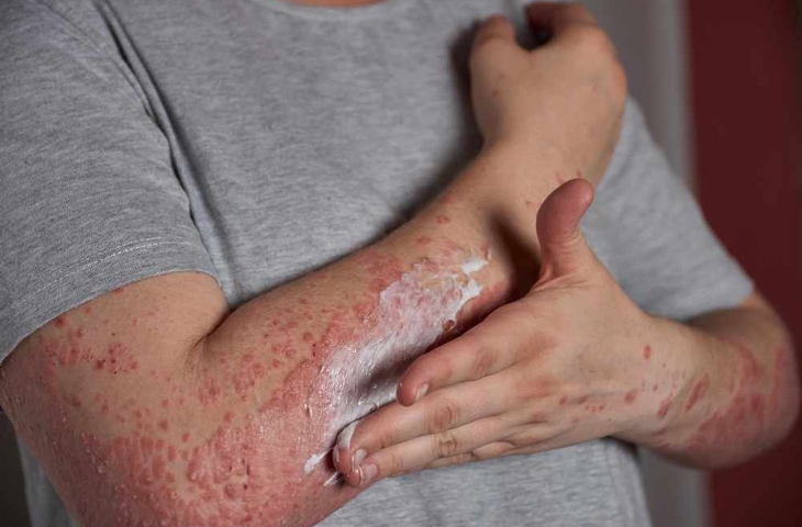 Ai có nguy cơ mắc viêm da dị ứng?- Ảnh 1.