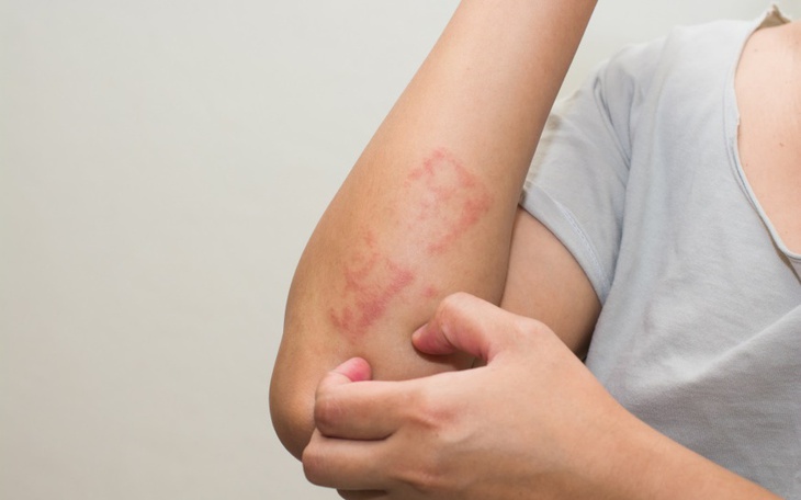 Điều gì sẽ xảy ra khi dùng quá nhiều corticoid trị viêm da dị ứng?