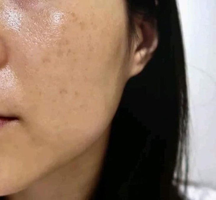 Ưu và nhược điểm của các biện pháp trị nám da- Ảnh 1.