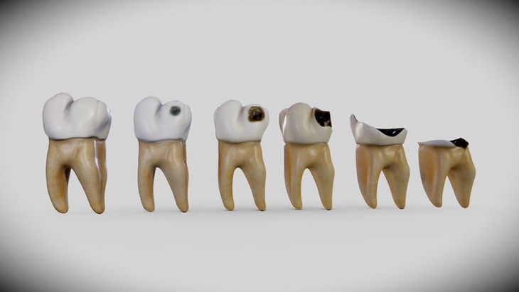 6 biểu hiện của sâu răng cần lưu ý- Ảnh 1. 6 biểu hiện của sâu răng cần lưu ý- Ảnh 1.