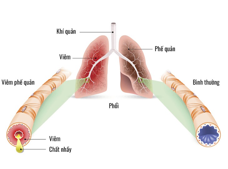 Những triệu chứng viêm phế quản cấp cần lưu ý- Ảnh 1.