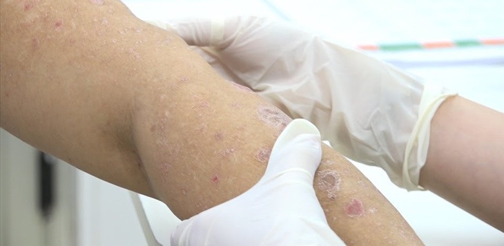 Vảy nến thường xuất hiện dưới dạng các mảng màu đỏ có vảy trắng ở mặt sau cẳng tay, cẳng chân, vùng rốn và da đầu.
