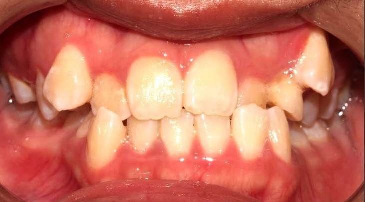 Khi răng sứ trở thành mối lo: Nguy cơ viêm nhiễm từ phục hình không đạt chuẩn- Ảnh 1. Khi răng sứ trở thành mối lo: Nguy cơ viêm nhiễm từ phục hình không đạt chuẩn- Ảnh 1.