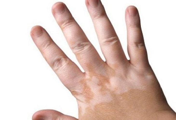 Bạch tạng: Nguyên nhân, biểu hiện, cách điều trị và phòng bệnh- Ảnh 1.