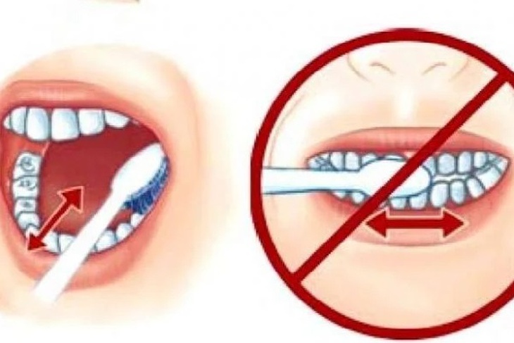 Mòn răng: Nguyên nhân, triệu chứng, cách điều trị và phòng bệnh- Ảnh 2.