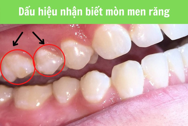 Các phương pháp điều trị mòn răng- Ảnh 1.