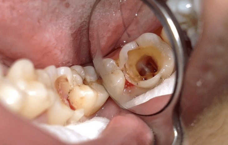 Câu hỏi liên quan đến mòn răng- Ảnh 1.