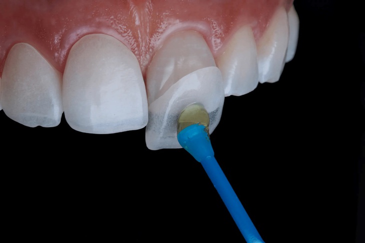 Các phương pháp điều trị mòn răng- Ảnh 4.