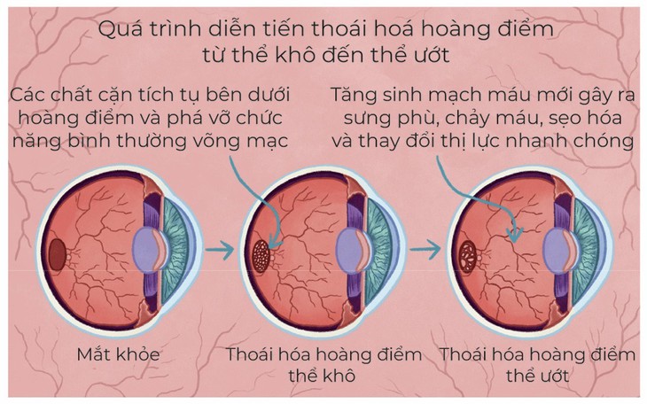 Thoái hóa hoàng điểm tuổi già - đừng bỏ quên đôi mắt mẹ cha- Ảnh 3.
