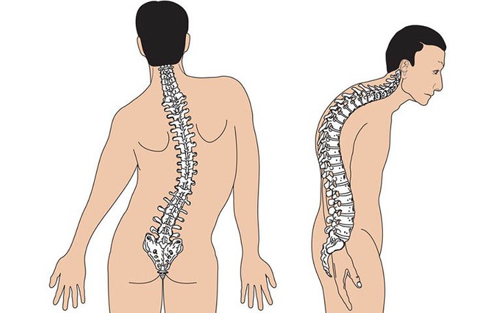 Các biện pháp điều trị gù cột sống