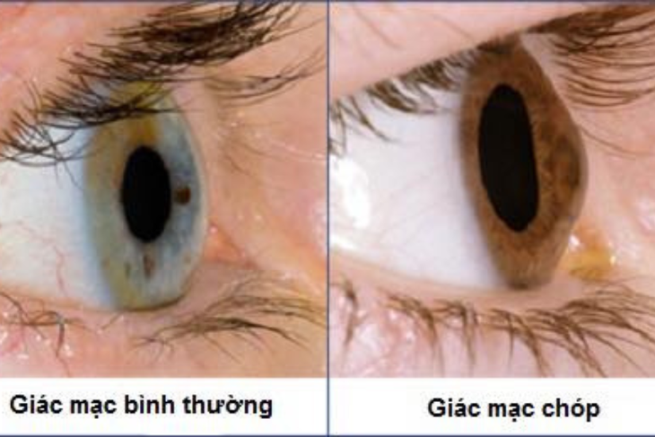 Bệnh giác mạc chóp: Nguyên nhân, biểu hiện, cách điều trị và phòng bệnh- Ảnh 1. Bệnh giác mạc chóp: Nguyên nhân, biểu hiện, cách điều trị và phòng bệnh- Ảnh 1.