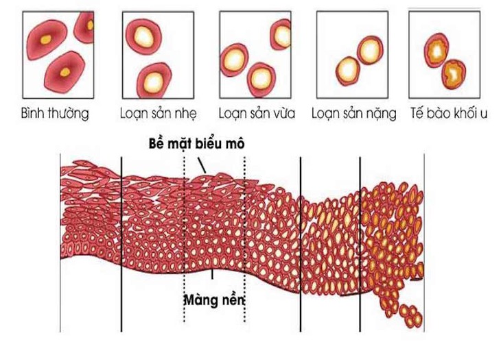 Loạn sản cổ tử cung: Nguyên nhân, triệu chứng, cách điều trị và phòng ngừa- Ảnh 1. Loạn sản cổ tử cung: Nguyên nhân, triệu chứng, cách điều trị và phòng ngừa- Ảnh 1.