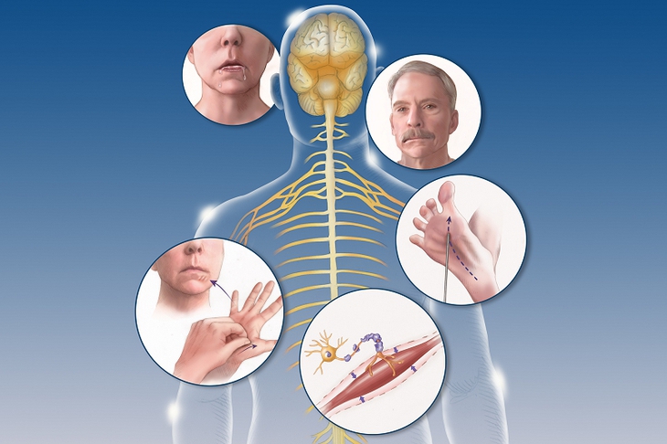 Bệnh xơ cột bên teo cơ: Nguyên nhân, triệu chứng, cách điều trị và phòng bệnh- Ảnh 1. Bệnh xơ cột bên teo cơ: Nguyên nhân, triệu chứng, cách điều trị và phòng bệnh- Ảnh 1.
