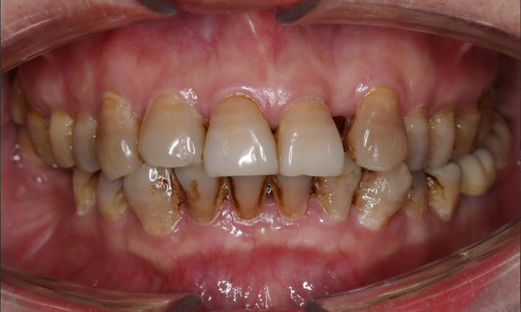 Răng xỉn màu làm cách nào để trắng sáng?- Ảnh 1.