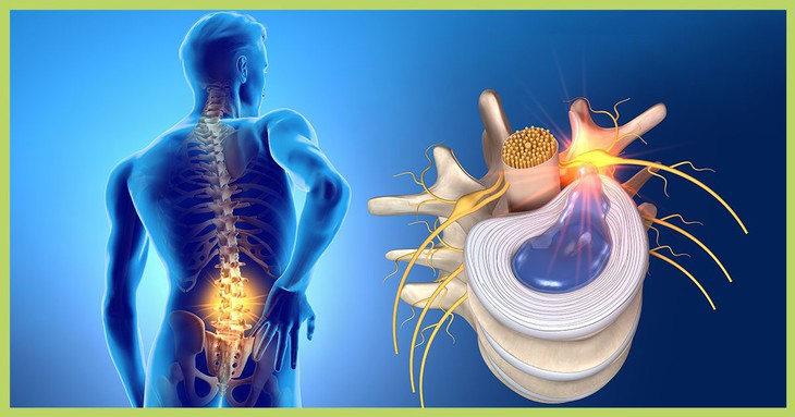 Nguy cơ liệt nếu không điều trị thoát vị đĩa đệm- Ảnh 1.