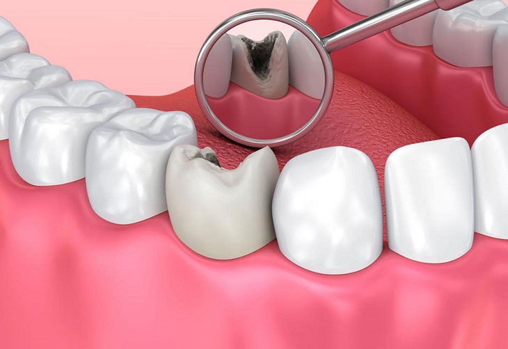 Thuốc và các biện pháp khắc phục hôi miệng- Ảnh 1.