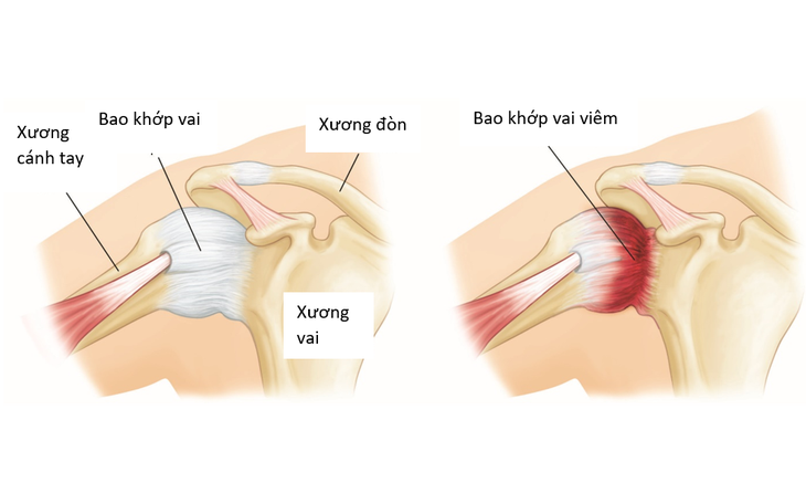 Viêm chóp xoay: Nguyên nhân, triệu chứng, cách điều trị và các biện pháp phòng ngừa