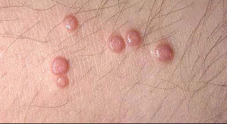 Mụn cóc sinh dục là một trong những bệnh lây truyền qua đường tình dục phổ biến.