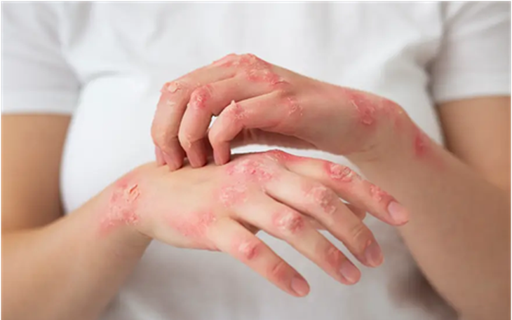 Thuốc điều trị bệnh ghẻ