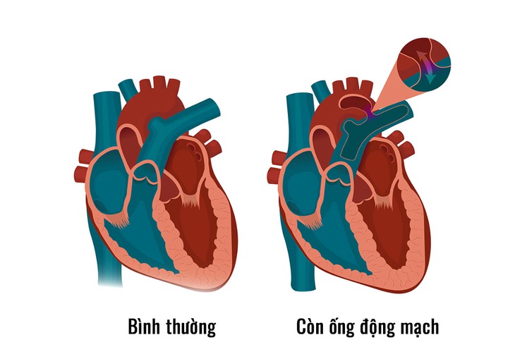 Còn ống động mạch: Nguyên nhân, triệu chứng, cách phòng ngừa và điều trị- Ảnh 2.