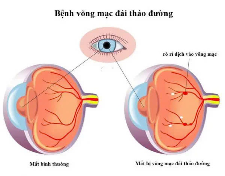 Bệnh võng mạc: Nguyên nhân, triệu chứng, phòng bệnh và cách điều trị- Ảnh 2. Bệnh võng mạc: Nguyên nhân, triệu chứng, phòng bệnh và cách điều trị- Ảnh 2.