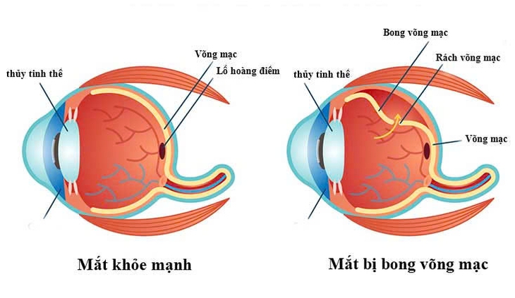 Những câu hỏi thường gặp về bệnh võng mạc- Ảnh 1.