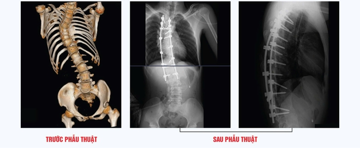 Hình ảnh cột sống bệnh nhân T. trước và sau phẫu thuật. Hình ảnh cột sống bệnh nhân T. trước và sau phẫu thuật.