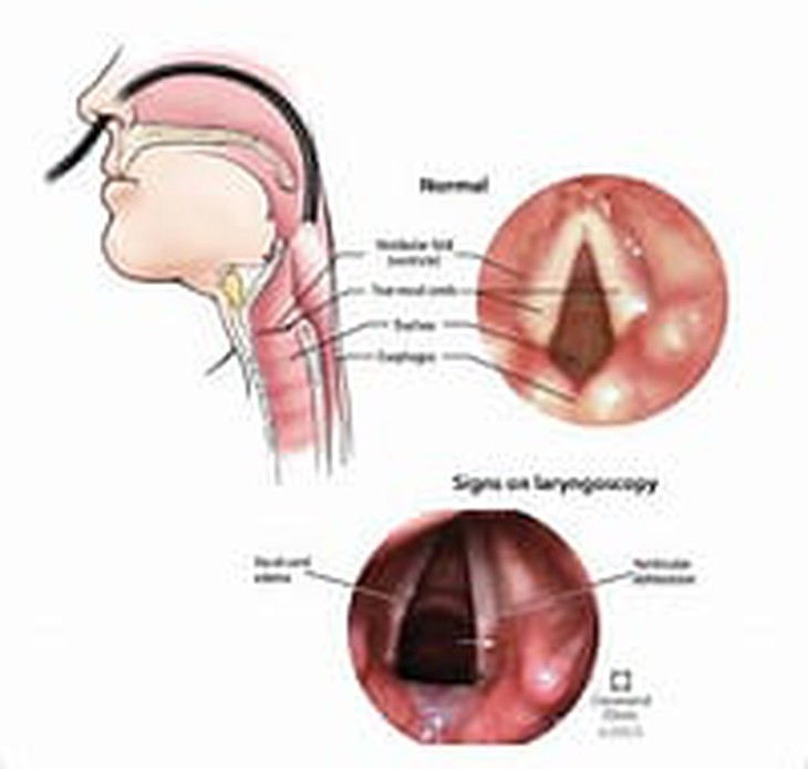 Viêm thanh quản mãn tính: Nguyên nhân, triệu chứng, phòng bệnh và cách điều trị- Ảnh 1. Viêm thanh quản mãn tính: Nguyên nhân, triệu chứng, phòng bệnh và cách điều trị- Ảnh 1.