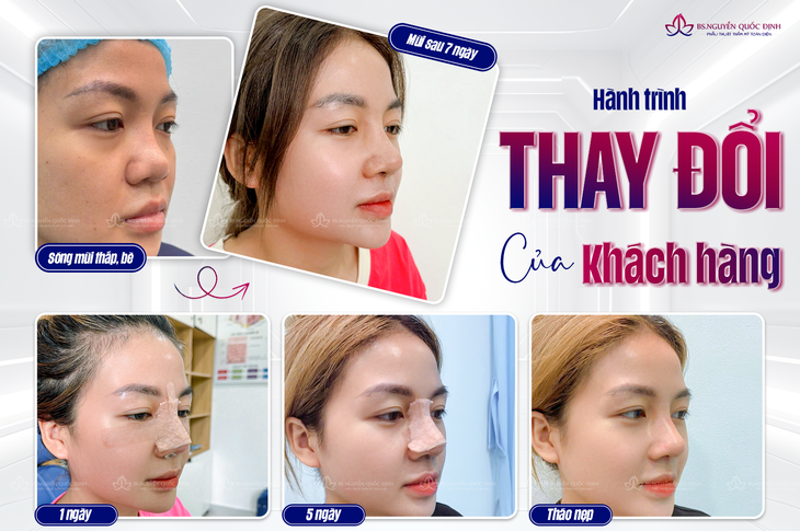 Lấy lại vẻ đẹp hoàn mỹ sau 2 lần nâng mũi thất bại- Ảnh 2.