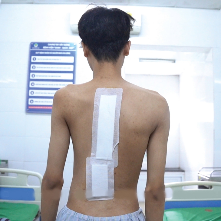 Phẫu thuật chỉnh cột sống hình chữ 'S' thành công cho thanh niên 23 tuổi- Ảnh 4. Phẫu thuật chỉnh cột sống hình chữ 'S' thành công cho thanh niên 23 tuổi- Ảnh 4.