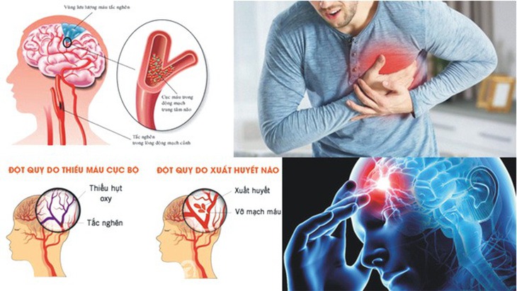 Nhồi máu não: Nguyên nhân, triệu chứng, cách điều trị và phòng ngừa- Ảnh 1. Nhồi máu não: Nguyên nhân, triệu chứng, cách điều trị và phòng ngừa- Ảnh 1.