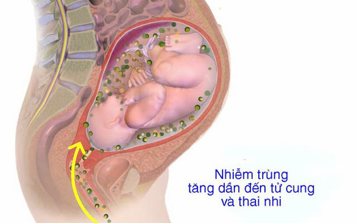 Bệnh viêm màng ối: Nguyên nhân, triệu chứng, phòng bệnh và cách điều trị