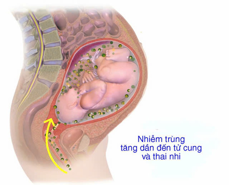 Bệnh viêm màng ối: Nguyên nhân, triệu chứng, phòng bệnh và cách điều trị- Ảnh 1. Bệnh viêm màng ối: Nguyên nhân, triệu chứng, phòng bệnh và cách điều trị- Ảnh 1.