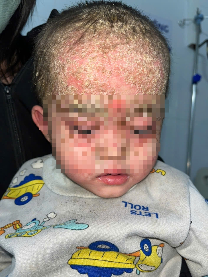 Da đầu đóng vảy từng mảng, toàn thân trẻ lở loét vì tự chữa vảy nến- Ảnh 5. Da đầu đóng vảy từng mảng, toàn thân trẻ lở loét vì tự chữa vảy nến- Ảnh 5.
