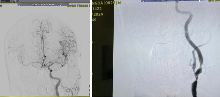 Cấp cứu vì chóng mặt bỗng phát hiện bệnh tim- Ảnh 1.