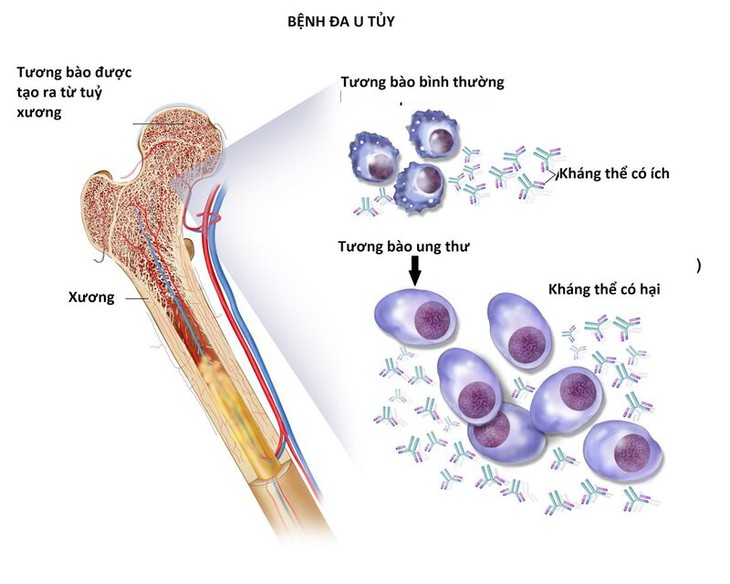 5 câu hỏi thường gặp với bệnh đa u tủy xương- Ảnh 1.