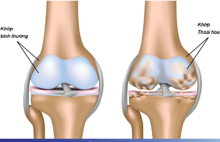 Thoái hóa khớp xảy ra liên quan đến độ tuổi. Ảnh minh họa