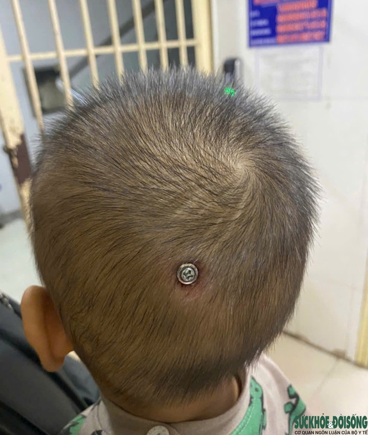 Cứu sống bé trai bị đinh vít đâm vào đầu- Ảnh 1. Cứu sống bé trai bị đinh vít đâm vào đầu- Ảnh 1.