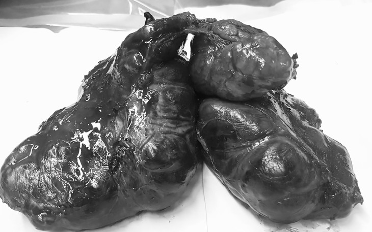 Bệnh nhân basedow 12 năm có khối bướu 'cực khủng' phải vào viện cấp cứu- Ảnh 1.