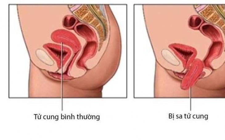 Sa sinh dục có biểu hiện như thế nào?