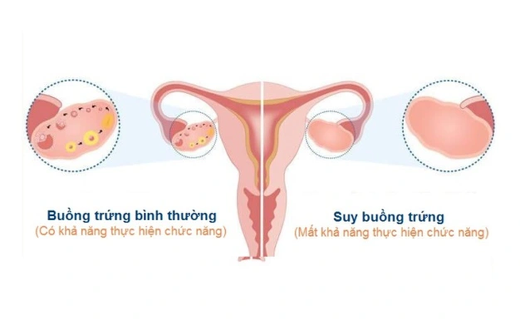 Suy buồng trứng: Nguyên nhân, triệu chứng, cách phòng ngừa