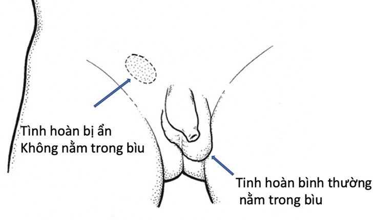 Câu hỏi thường gặp liên quan đến bệnh tinh hoàn ẩn- Ảnh 1. Câu hỏi thường gặp liên quan đến bệnh tinh hoàn ẩn- Ảnh 1.