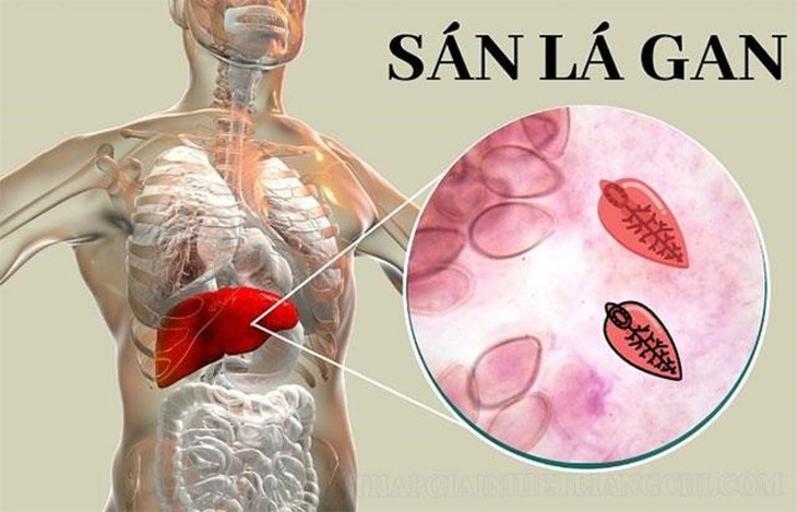 Để chẩn đoán một ca bệnh sán lá gan, bác sĩ cần phối hợp các thông tin về đặc điểm dịch tễ, triệu chứng lâm sàng và các xét nghiệm cận lâm sàng.