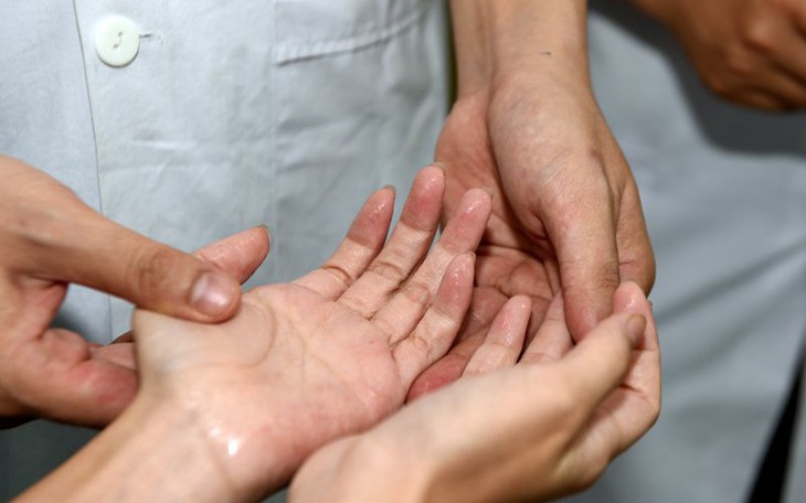 Ra mồ hôi tay nhiều phải làm sao?