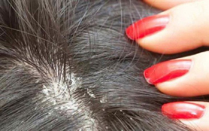 Nấm sinh trưởng và phát triển mạnh trong môi trường ấm áp, độ ẩm cao và da đầu là nơi lý tưởng. Nấm sinh trưởng và phát triển mạnh trong môi trường ấm áp, độ ẩm cao và da đầu là nơi lý tưởng.