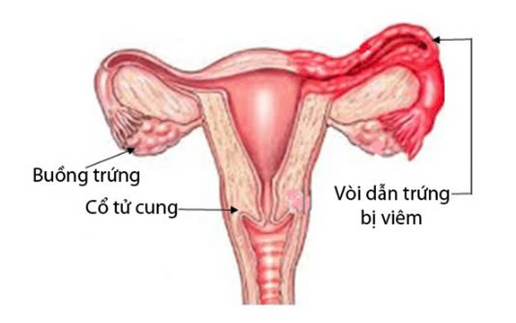 Viêm ống dẫn trứng: Nguyên nhân, triệu chứng, phòng bệnh và cách điều trị