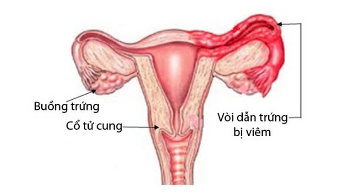 Viêm ống dẫn trứng: Nguyên nhân, triệu chứng, phòng bệnh và cách điều trị- Ảnh 1. Viêm ống dẫn trứng: Nguyên nhân, triệu chứng, phòng bệnh và cách điều trị- Ảnh 1.